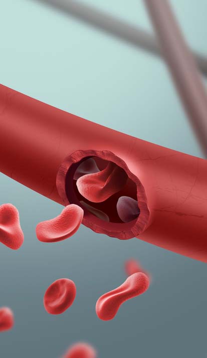 파열성 뇌동맥류