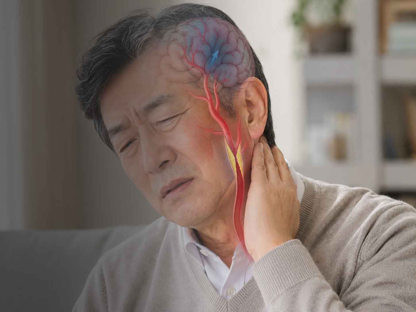 경동맥협착증 진단과 치료